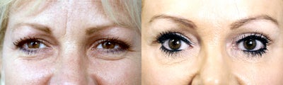Brow Lift before and after photo