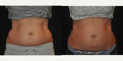 CoolSculpting before and after photo