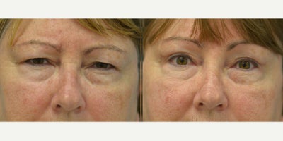 Eyelid Surgery before and after photo