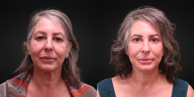 Facelift before and after photo