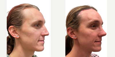 Facial Feminization Surgery before and after photo