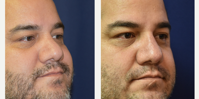 Nonsurgical Nose Job before and after photo