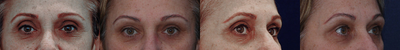 Restylane before and after photo