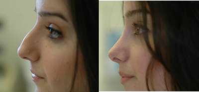 Rhinoplasty before and after photo