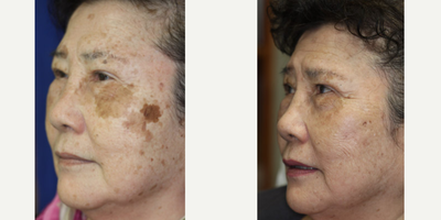 YAG Laser before and after photo