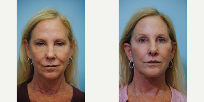 Lip Lift before and after photo