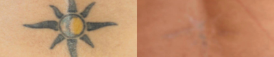 Tattoo Removal before and after photo