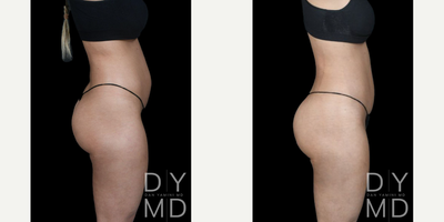 Brazilian Butt Lift before and after photo