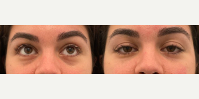 Dermal Fillers before and after photo