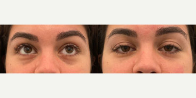 Dermal Fillers before and after photo