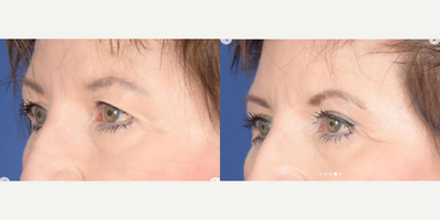 Eyelid Surgery before and after photo