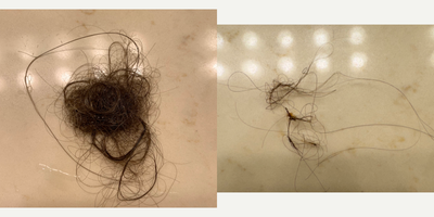 Hair Loss Treatment before and after photo