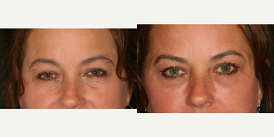 Restylane before and after photo