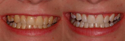 Zoom Whitening before and after photo