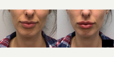 Dermal Fillers before and after photo