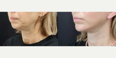 Facelift before and after photo