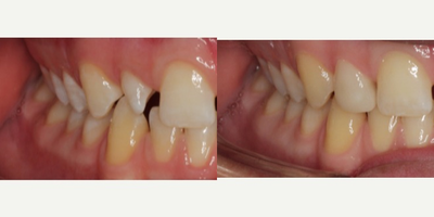 Lumineers before and after photo