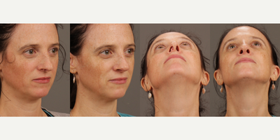 Septoplasty before and after photo