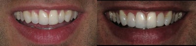 Smile Makeover before and after photo