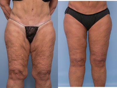 Thigh Lift before and after photo