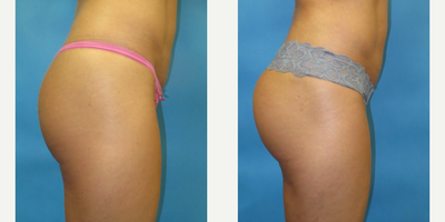 Brazilian Butt Lift before and after photo