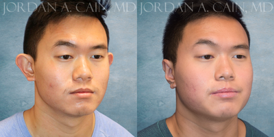 Ear Surgery before and after photo