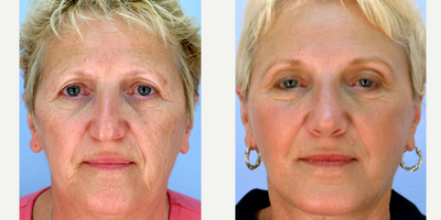 Facelift before and after photo
