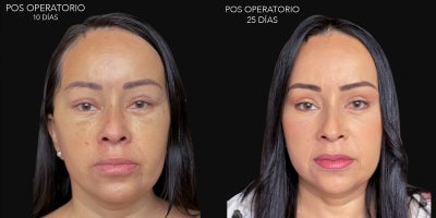 Facelift before and after photo