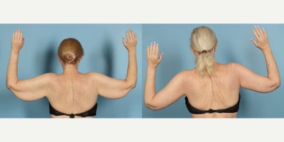 Arm Lift before and after photo