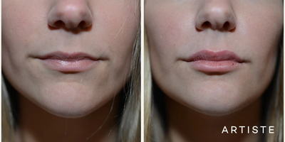 Lip Fillers before and after photo