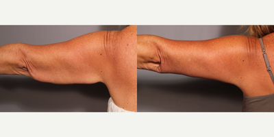 Arm Lift before and after photo