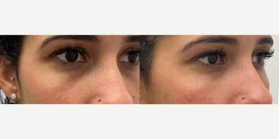 Belotero before and after photo