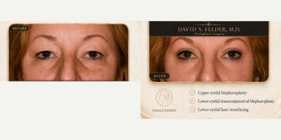 Eyelid Surgery before and after photo