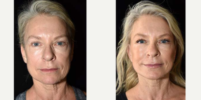 Facelift before and after photo