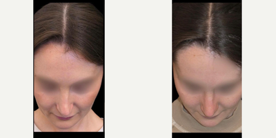 Revision Rhinoplasty before and after photo