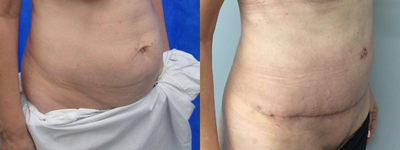 Tummy Tuck before and after photo