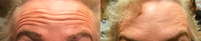 Botox before and after photo