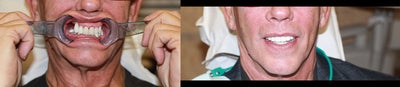 Smile Makeover before and after photo