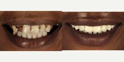 All-on-4 Dental Implants before and after photo
