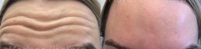 Botox before and after photo