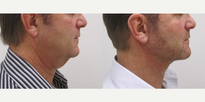 Facelift before and after photo