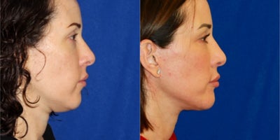 Mini Facelift before and after photo