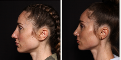 Rhinoplasty before and after photo