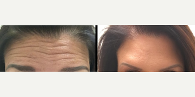 Botox before and after photo