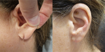 Earlobe Repair before and after photo