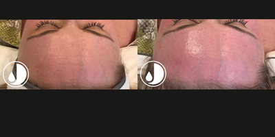 HydraFacial before and after photo