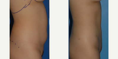 Tumescent Liposuction before and after photo