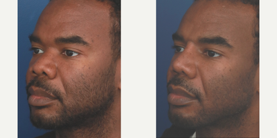 African American Rhinoplasty before and after photo