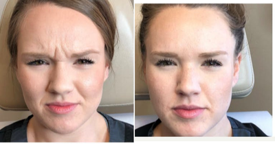 Botox before and after photo