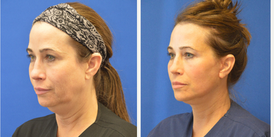 Facelift before and after photo